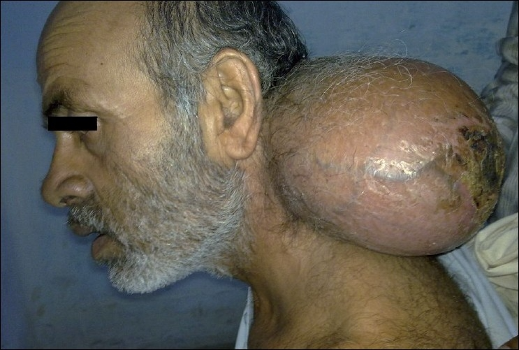 Swelling and discomfort